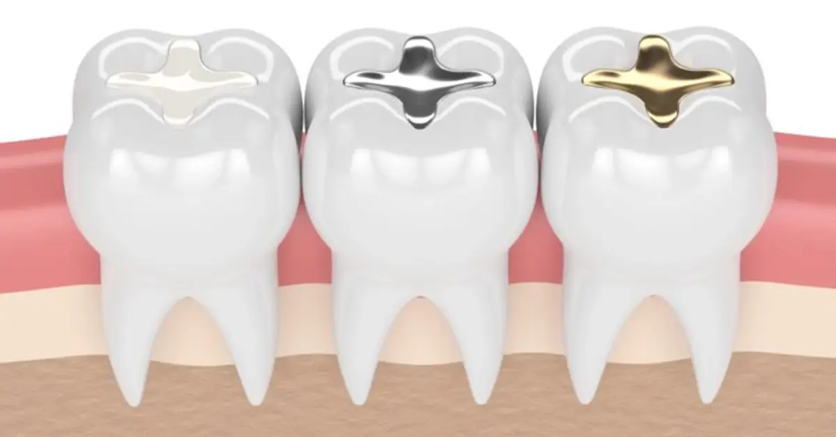Teeth Fillings